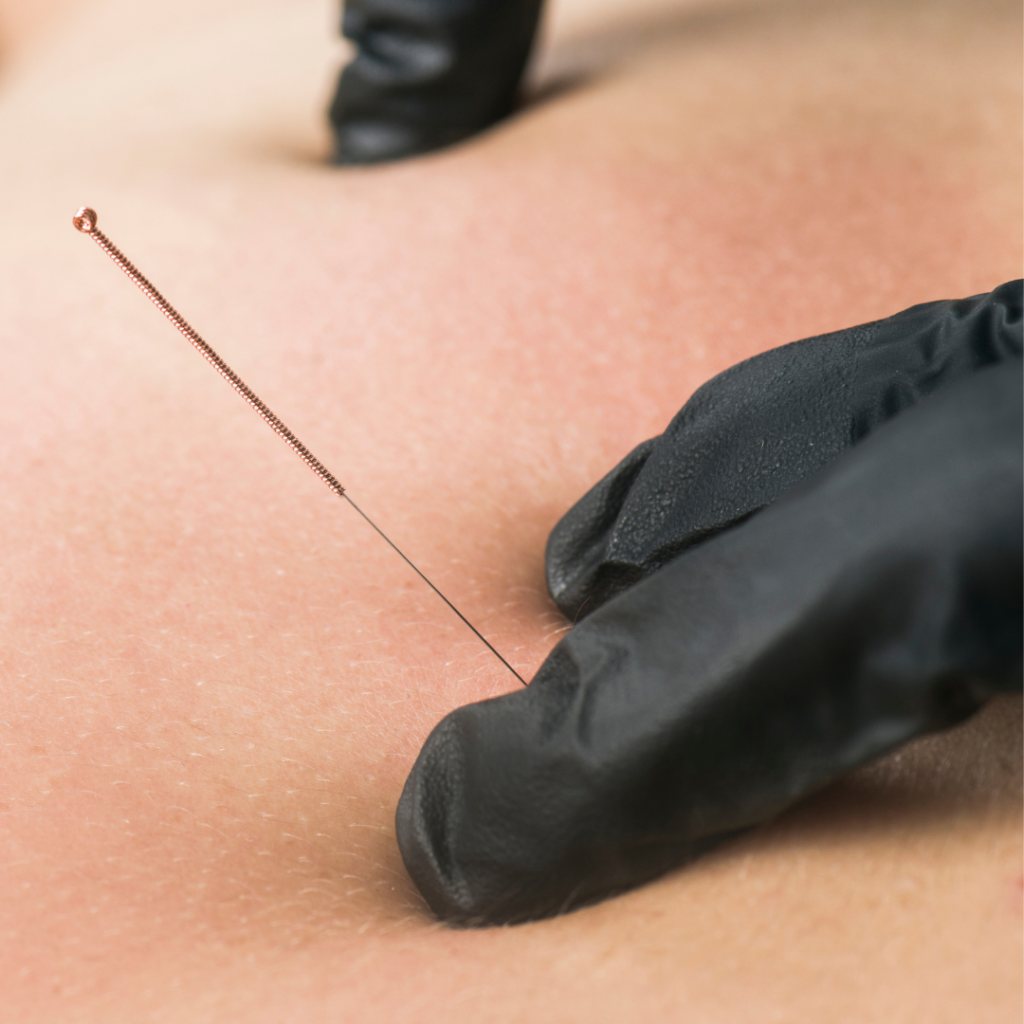Dry Needling Physical Therapy Chicago
