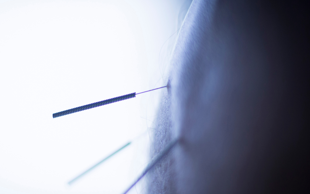 What Can Dry Needling Treat?